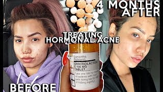 Treating my Hormonal Cystic Acne with Spirolactone  4 MONTHS Before amp Afters  ProsCons [upl. by Hammerskjold]