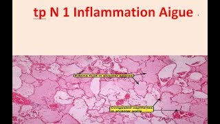 TP ANAPATHInflammation aiguë [upl. by Snashall45]