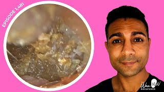 1482  Routine Ear Wax Removal Unearths Canal Epithelial Hyperplasia [upl. by Assiar]