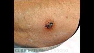 Skin cancer cured without radiation or surgery [upl. by Lindly]