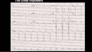 1215 Lead ECG MI Imposter 3 [upl. by Anirrak]