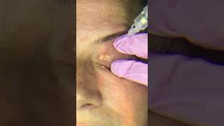 Xanthelasma removal [upl. by Canica307]