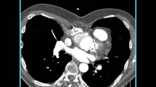 Cardiac Pseudoaneurysm of ascending aorta 2 of 5 [upl. by Lavern183]