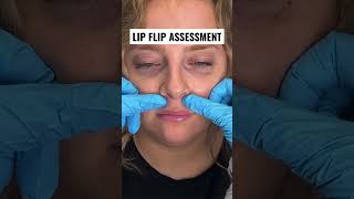 How a Botox lip flip works 💉 reels lipflip botox botoxinjections [upl. by Blanc847]