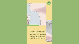 How To Remove a Hickey in Seconds with Toothpaste [upl. by Kenwood]