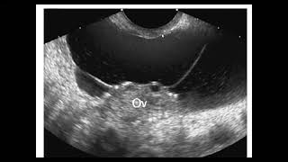 Peritoneal inclusion cyst [upl. by Uke]