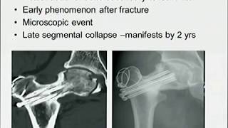 Neck of femur fractures [upl. by Dnalyr]