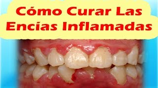 COMO CURAR LAS ENCIAS INFLAMADAS RAPIDO  2 Potentes Remedios Caseros Para Encias Inflamadas [upl. by Amoeji]