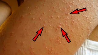 Natural Treatment to Get Rid of Keratosis Pilaris Chicken Skin [upl. by Selin]