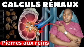 Calculs rénaux  Comment sen débarrasser rapidement   Dr Touré [upl. by Aled]