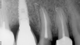 Endodoncia completa premolar superior [upl. by Eelram]