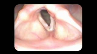 Vocal cord paralysis with nodules [upl. by Ittocs]