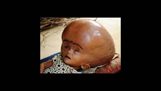 Hydrocephalus awareness month [upl. by Obeng]