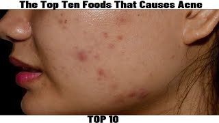 The Top Ten 10 Foods That Causes Acne [upl. by Aisats]