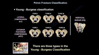 Pelvic Fractures  Everything You Need To Know  Dr Nabil Ebraheim [upl. by Ahsirtal]