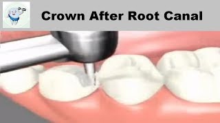 Dental Crown Procedure After Root Canal [upl. by Gadmon]