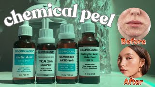 Chemical Peel At Home  Chemical Peel Treatment  skin peeling [upl. by Setsero]