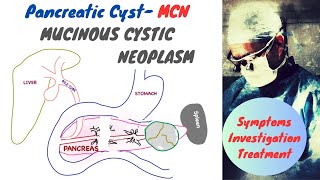 Pancreatic Cyst  Mucinous Cystic Neoplasm MCN [upl. by Smallman]