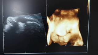 3D  4D Baby Ultraschall im 8 Monat 3D Ultrasound 33rd Week of Pregnancy [upl. by Langham184]