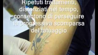 Rimozione di un tatuaggio Prof Luigi Di Girolamo [upl. by Ralip]