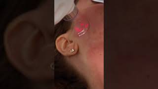 Transform Your Skin Dr Tripathi Demonstrates RF Microneedling and CO2 Treatments [upl. by Ardnovahs]