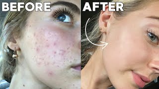 How I Cleared My Skin In 8 Weeks naturally [upl. by Eibrad244]