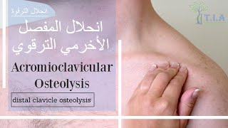 انحلال المفصل الأخرمي الترقوي acromioclavicular osteolysis subtitled [upl. by Albers767]