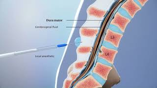 Lumbar Puncture 101  Understanding Study Procedures in ALS Clinical Trials [upl. by Watters]