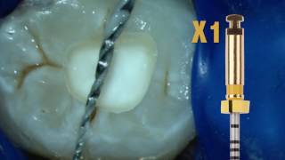 ProTaper Next™ Technique with Dr Scianamblo  Dentsply Sirona [upl. by Ddej]