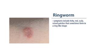 Skin Infections Ringworm [upl. by Berkshire]