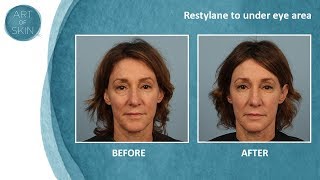 Undereye filler with Restylane Dr Palm San Diego [upl. by Volotta442]