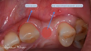 Buccal Roll Flap [upl. by Fishback585]