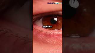 Trachoma The Eye Disease Blinding Millions Worldwide shorts healthtips healthtime6469 [upl. by Delastre687]