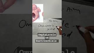 OmphaLocele vs gastroschisis shorts ytshorts fmgeians neetpg medicine [upl. by Cynarra]