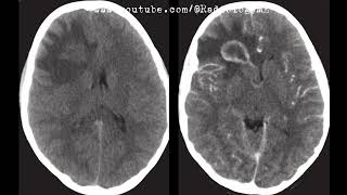 Case 58 Axial views from a CT scan of the brain [upl. by Elwee]