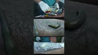 Psoriasis Relief with Leech Therapy [upl. by Yesnil]