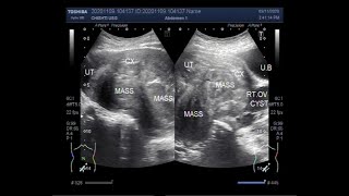 Ultrasound Video showing two large masses in cul de sac [upl. by Inimak]