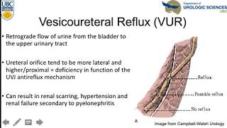 Vesicoureteral Reflux An Update [upl. by Ailet]