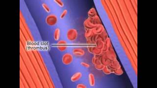 Formation of Deep Vein Thrombosis [upl. by Aletse]