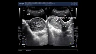 Endometrial Hyperplasia and Hemorrhagic Ovarian Cyst [upl. by Notxam]