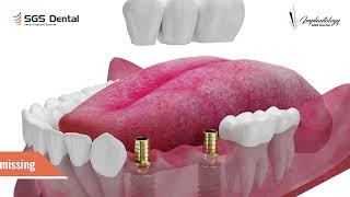 SGS Dental Swiss Implant System [upl. by Stephannie204]