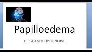 Ophthalmology Papilledema amaurosis fugax sometimes loss of vision cant see Hayreh theory [upl. by Hankins]