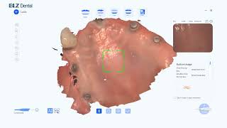 🌟BLZ Dental Intraoral Scanner Real Case StudyEdentulous Patient Case📋 [upl. by Jacinda]