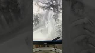 Lateral video fluoroscopy  how does it look [upl. by Leraj]