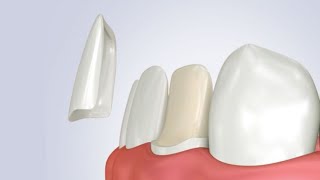 Cementazione faccetta dentale in disilicato di litio step by step [upl. by Nage361]