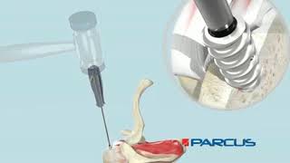 Parcus Titanium V LoX Suture Anchor Animation lLu57zbs k [upl. by Esadnac]