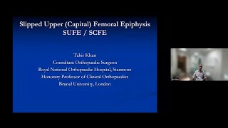 Slipped upper capital femoral epiphysis SUFE by Mr Tahir Khan [upl. by Retsehc661]