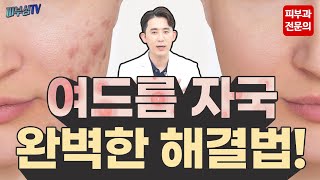 여드름 자국 완벽한 해결법 피부과전문의 피부심 [upl. by Llenahs48]