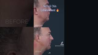 Neck Liposuction and Chin implant  BEFORE and AFTER [upl. by Nirb883]