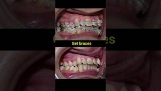 Braces transformation in 30 months braces orthodontist niengrang dentist bracket [upl. by Anauqahs]